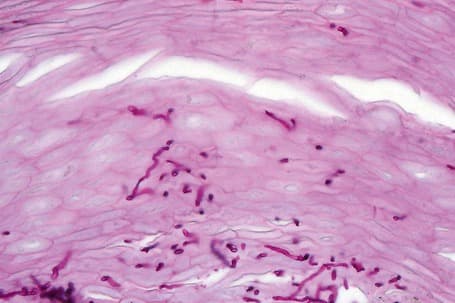 Nail Pathogen