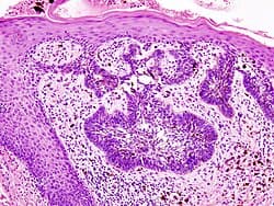 Wound Pathogen Panel